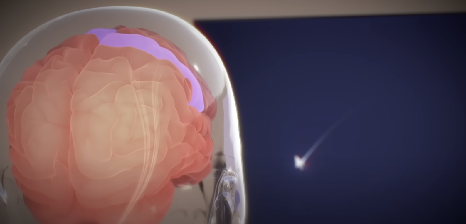 Den første implantatpasienten bruker hjernestyring